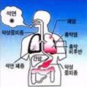 석면과건강