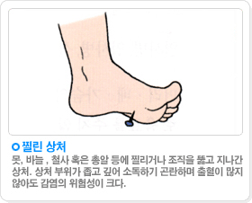 찔린상처:못, 바늘 , 철사 혹은 총알 등에 찔리거나 조직을 뚫고 지나간상처. 상처 부위가 좁고 깊어 소독하기 곤란하며 출혈이 많지 않아도 감염의 위험성이 크다.