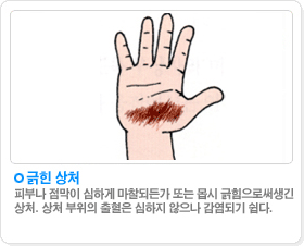 긁힌상처:피부나 점막이 심하게 마찰되든가 또는 몹시 긁힘으로써생긴 상처. 상처 부위의 출혈은 심하지 않으나 감염되기 쉽다.