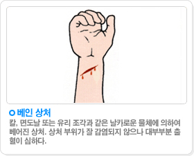 베인상처:칼, 면도날 또는 유리 조각과 같은 날카로운 물체에 의하여베어진 상처. 상처 부위가 잘 감염되지 않으나 대부부분 출
혈이 심하다.